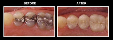 Tooth-colored Composite Fillings To Replace Silver